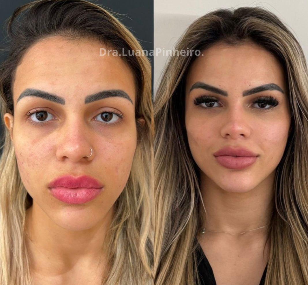 Harmonização Full Face