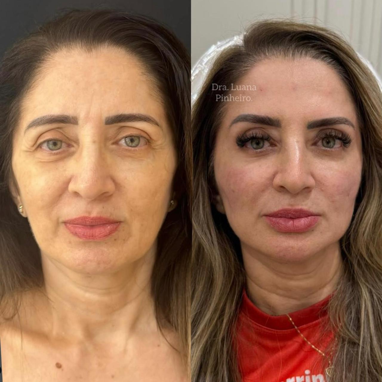 Harmonização Full Face