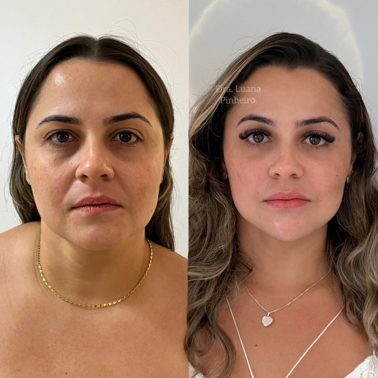 Harmonização Full Face