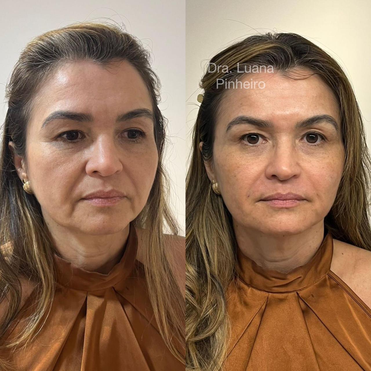 Harmonização Full Face